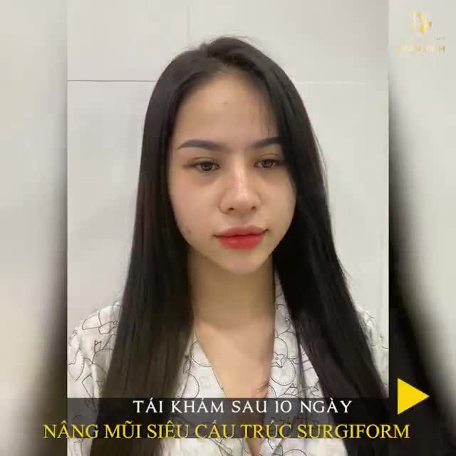 MŨI VÀO DÁNG NHANH SAU 10 NGÀY PHẪU THUẬT LÀ VÌ ĐÂU?