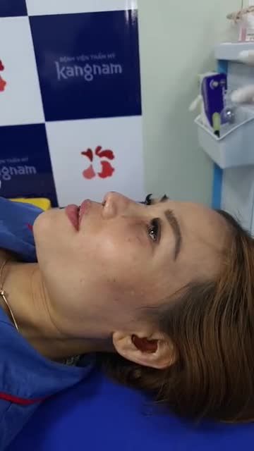 Muốn NÂNG MŨI ĐẸP cần CHUẨN từ khâu NẸP MŨI
