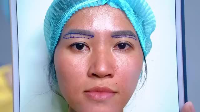 Nâng cung mày có thực sự giúp bạn trẻ ra 5 tuổi? Theo dõi video để có câu trả lời bạn nhé!
