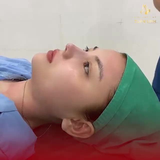 NÂNG MŨI BÁN CẤU TRÚC ĐẸP TỰ NHIÊN