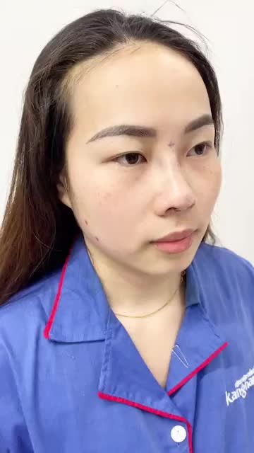 Nâng mũi Cấu trúc 4D Dịu dàng nét đẹp phụ nữ Việt