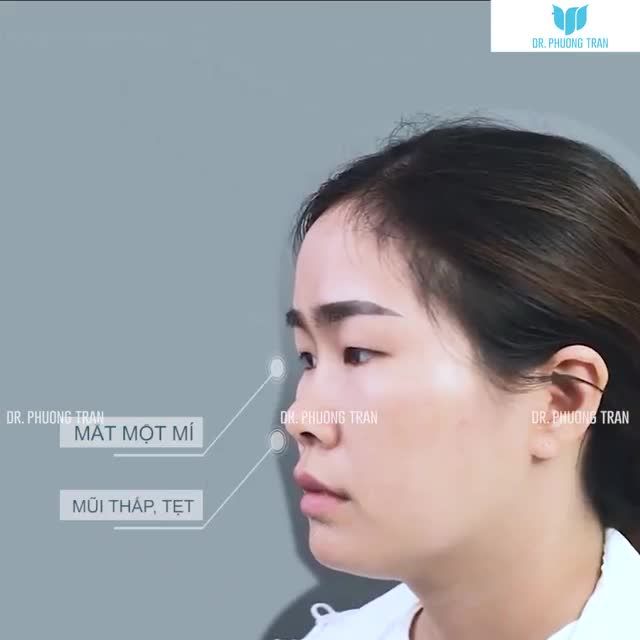 NÂNG MŨI CẤU TRÚC + CẮT MÍ + PHẪU THUẬT KHÔNG ĐAU
