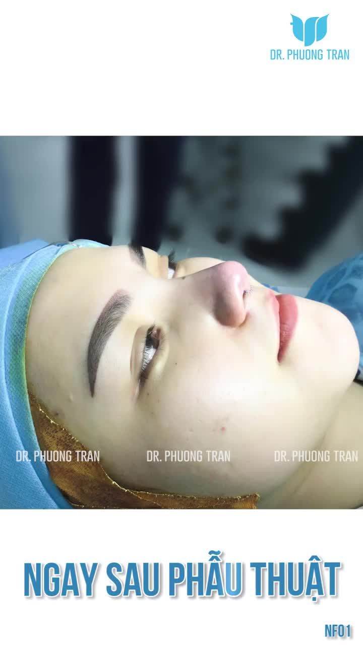NÂNG MŨI CẤU TRÚC ĐƯỢC BAO LÂU?