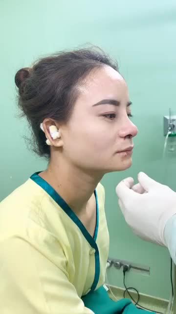 NÂNG MŨI CẤU TRÚC NANO - LÊN FORM MŨI ĐẸP TỰ NHIÊN