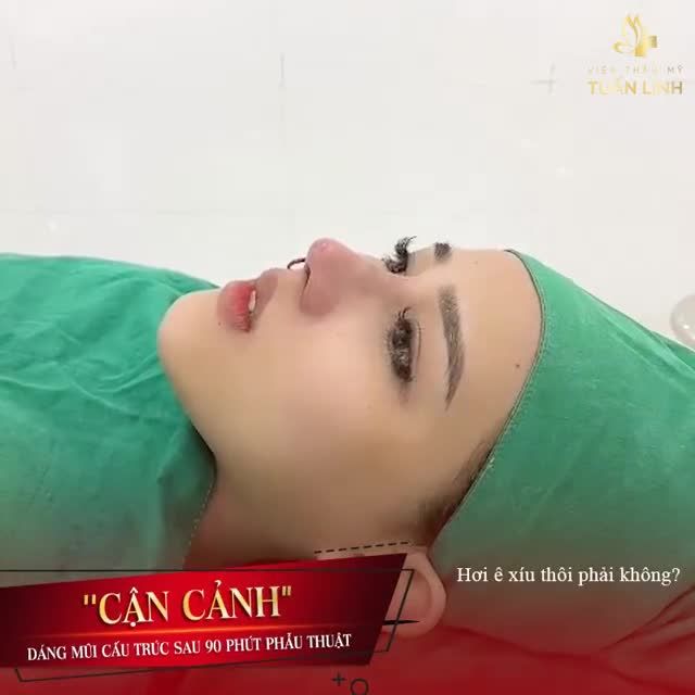 NÂNG MŨI CẤU TRÚC SAU 90 PHÚT.