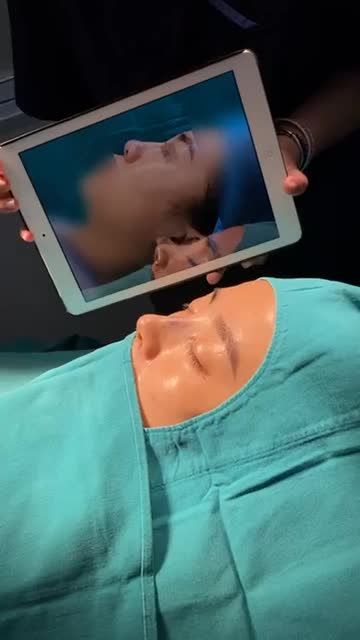 NÂNG MŨI CẤU TRÚC SOFTXIL - XOÁ BỎ DÁNG MŨI TẸT, NGẮN HẾCH