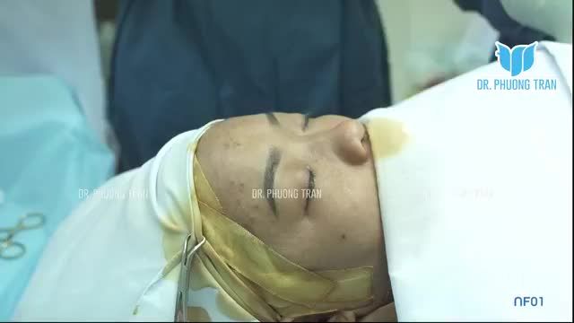 NÂNG MŨI CẤU TRÚC SỤN SƯỜN SURGIFORM TẠI BỆNH VIỆN