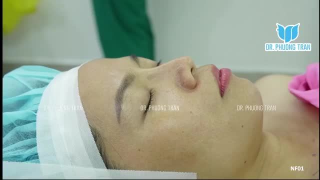 NÂNG MŨI CẤU TRÚC SỤN SƯỜN TOÀN PHẦN KHẮC PHỤC MŨI LỘ SỐNG, LUNG LAY, CỤP ĐẦU MŨI