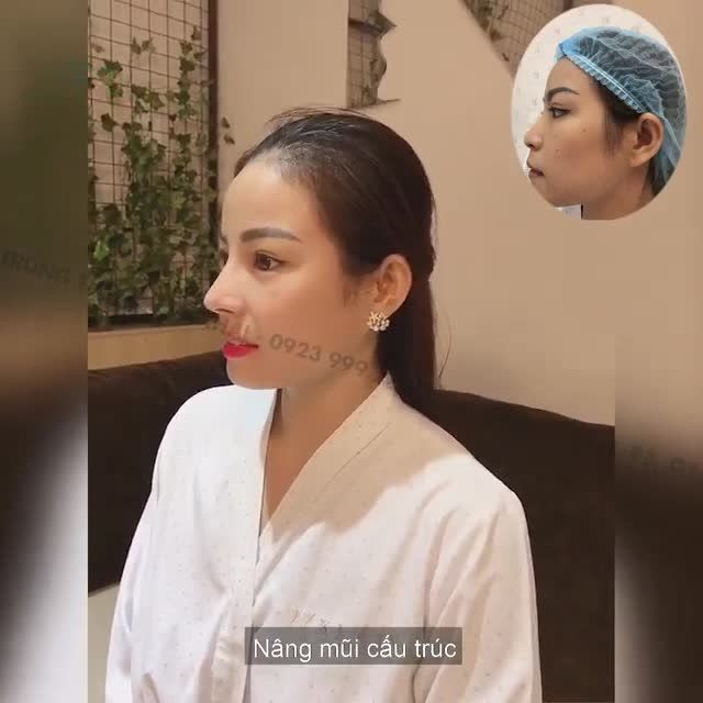 Nâng mũi cấu trúc Surgiform đang được trợ giá chỉ còn 49 triệu.