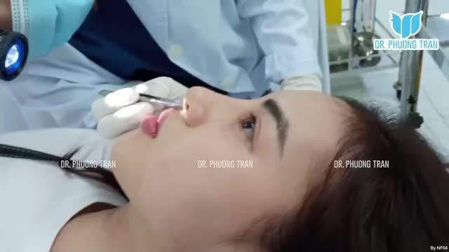 NÂNG MŨI ĐẶT SỐNG NHẸ NHÀNG NHƯ KHÔNG