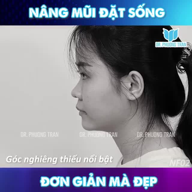 NÂNG MŨI ĐẶT SỐNG SURGIFORM - ĐƠN GIẢN + AN TOÀN VÀ HIỆU QUẢ!