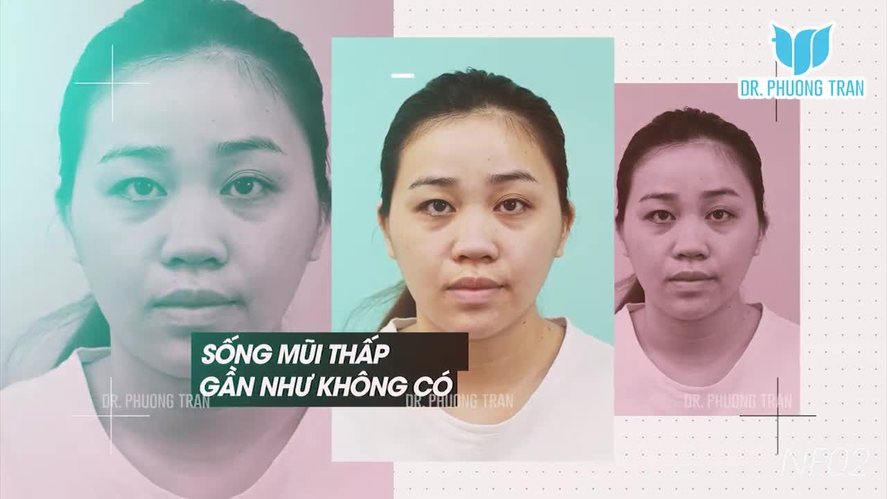 NÂNG MŨI GIÚP THAY ĐỔI DIỆN MẠO VÀ CUỘC SỐNG CỦA BẠN NHƯ THẾ NÀO?