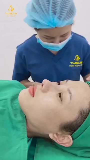 NÂNG MŨI HÀN QUỐC ĐƯỢC 10 NĂM BỊ BIẾN CHỨNG VÀ KẾT QUẢ SỬA LẠI SAU 90 PHÚT.