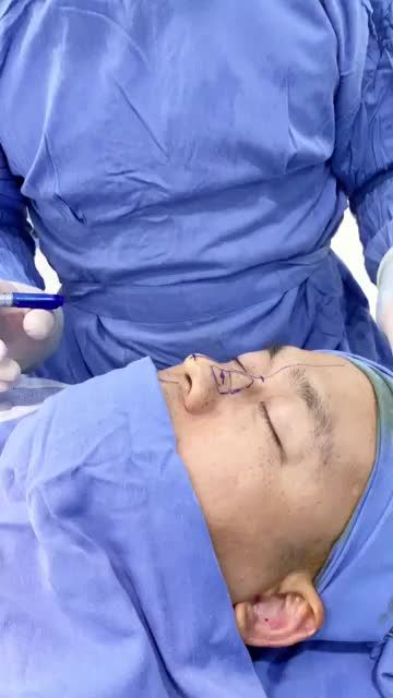 Nâng mũi kết hợp chỉnh xương mũi - Chuẩn SOÁI CA chỉ sau 90p