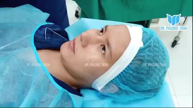 NÂNG MŨI KHÔNG PHẢI CỨ CAO LÀ SẼ ĐẸP