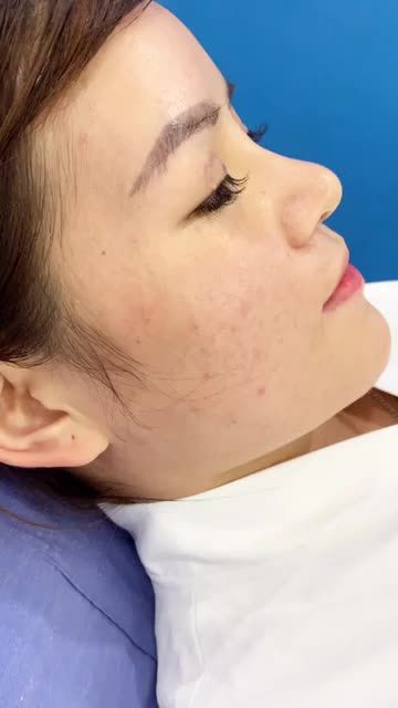 Nâng mũi mà nhìn thanh thoát tự nhiên như không thẩm mỹ
