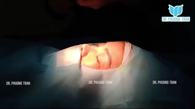 NÂNG MŨI SỤN SƯỜN TỰ THÂN CÓ TỐT KHÔNG? CÙNG NGHE BÁC SĨ PHÂN TÍCH NHÉ!