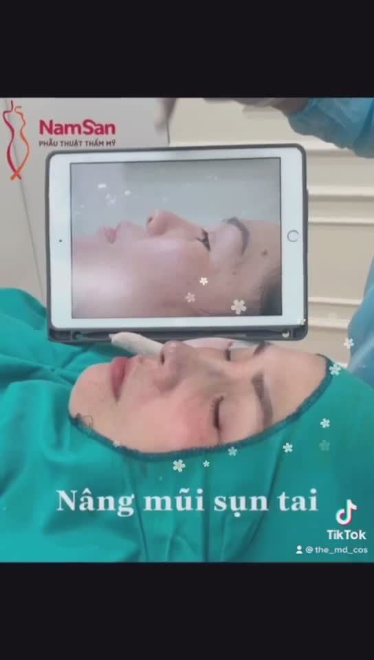 Nâng mũi sụn tai, làm xong đẹp liền