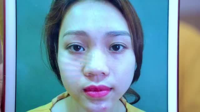 Nếu bạn đang có ý định sửa mí tại Dr.Hải Lê bạn không nên bỏ qua video này