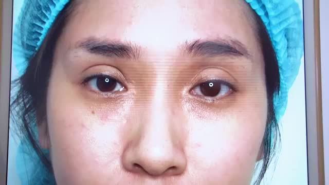Ngắm nhìn kết quả mí sủa tại Dr.Hải Lê trông sẽ như thế nào, liệu có đẹp như mong đợi của khách hàng.