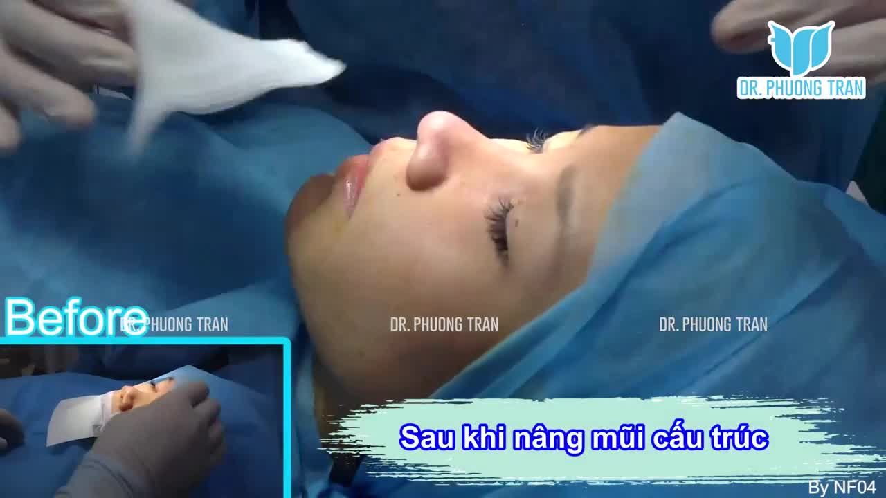 “NGHĨ SẼ ĐAU NHƯNG HOÀN TOÀN KHÔNG ĐAU”