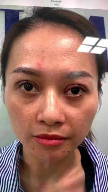 Nhiệm vụ xử lý ca mũi gãy, gồ, nền xương mũi to thô đã hoàn thành.