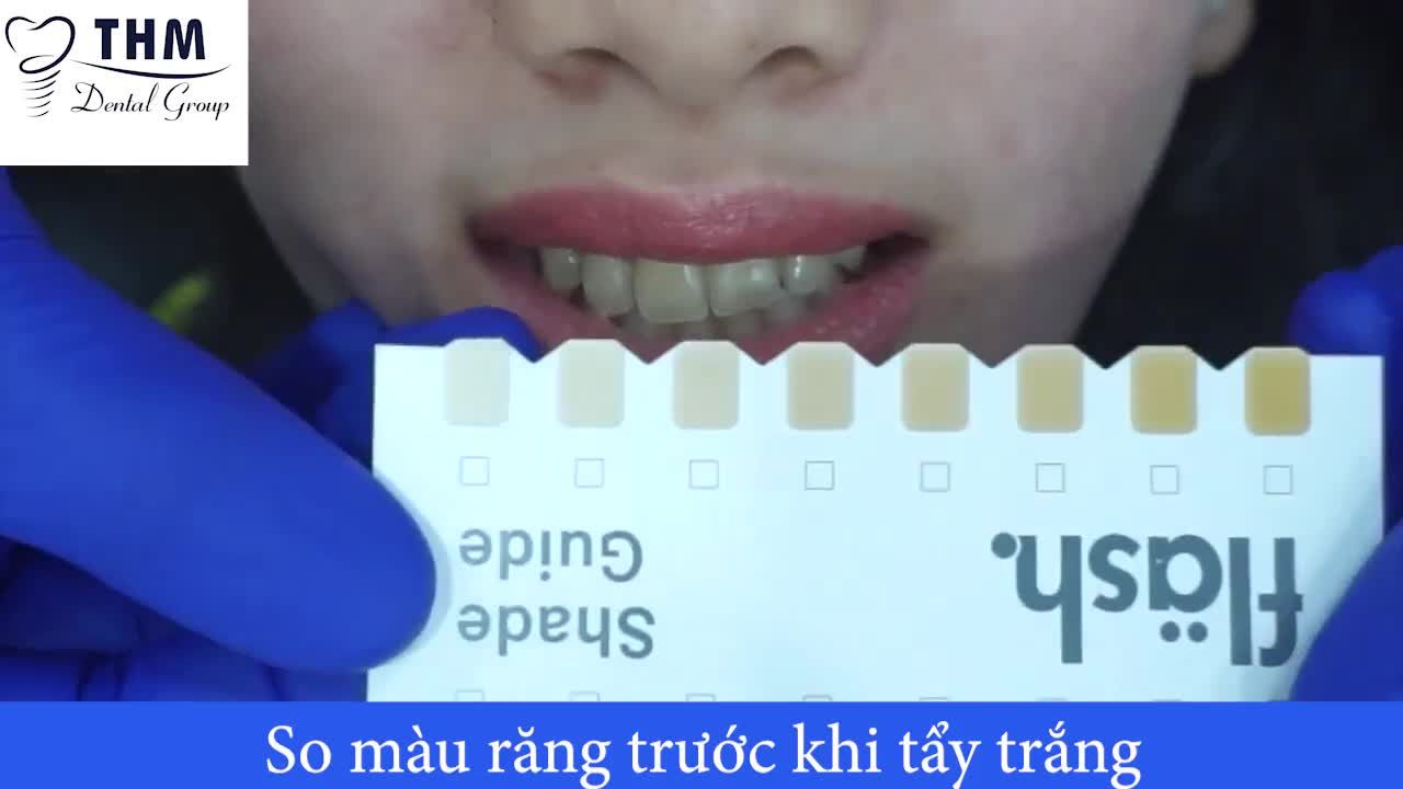 NHỮNG LƯU Ý TRƯỚC VS SAU KHI TẨY TRẮNG BẠN NÊN BIẾT