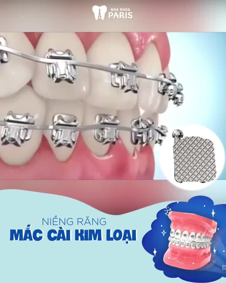 Niềng lại DÁNG RĂNG  "Lột xác" khuôn mặt