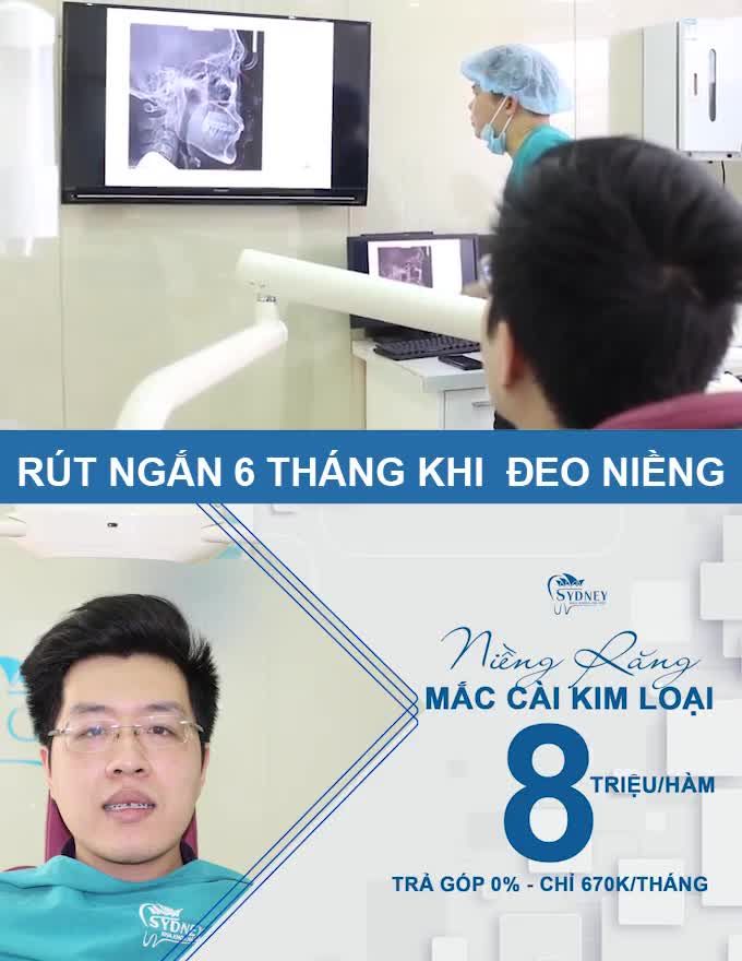 NIỀNG RĂNG SIÊU TIẾT KIỆM CÙNG MẮC CÀI KIM LOẠI