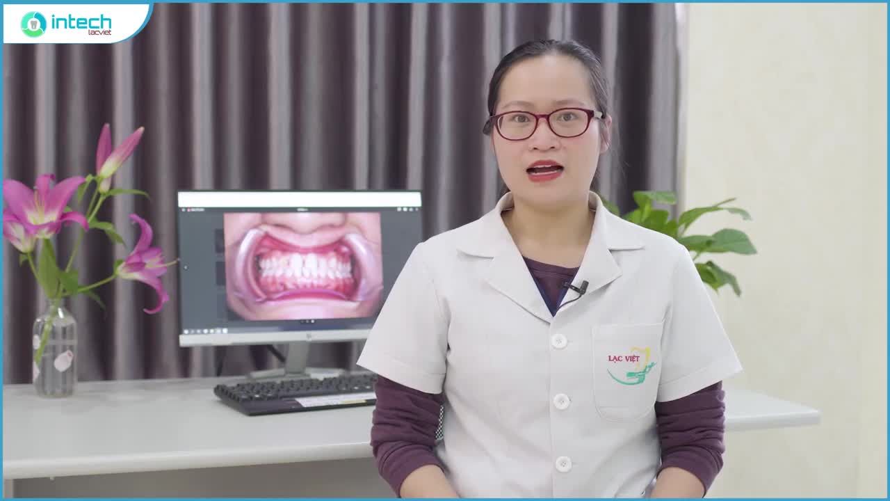 PHÂN TÍCH LÂM SÀNG CA RĂNG THƯA MÓM XƯƠNG HÀM TRÊN THAY ĐỔI TÍCH CỰC SAU 8 THÁNG ĐIỀU TRỊ