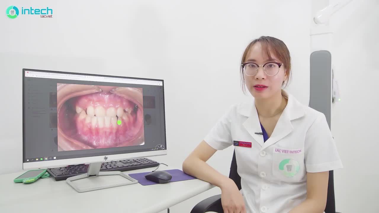 PHÂN TÍCH LÂM SÀNG- NIỀNG RĂNG MÓM Ở KHÁCH HÀNG 13 TUỔI