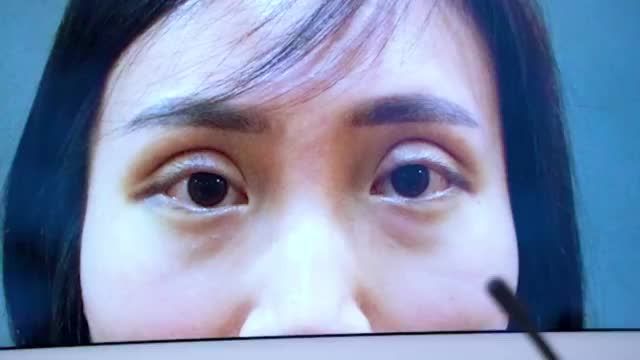 Phát hiện và sửa mí “lỗi, hỏng” trong thời điểm vàng có thể ngăn chặn hậu quả biến chứng thẩm mỹ nặng nề!