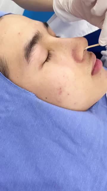 Quá trình cắt chỉ không đau, không lộ sẹo