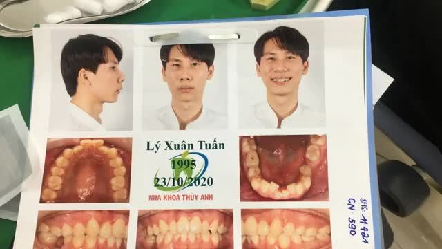 Quá trình cấy 2 minivít hàm trên cho bạn khách hàng tại nha khoa Thùy Anh.
