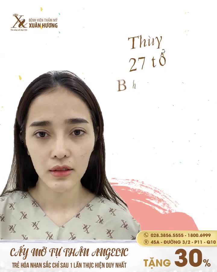Quá trình tìm đến khuôn mặt bầu bĩnh trẻ trung nhờ CẤY MỠ TỰ THÂN ANGELIC.