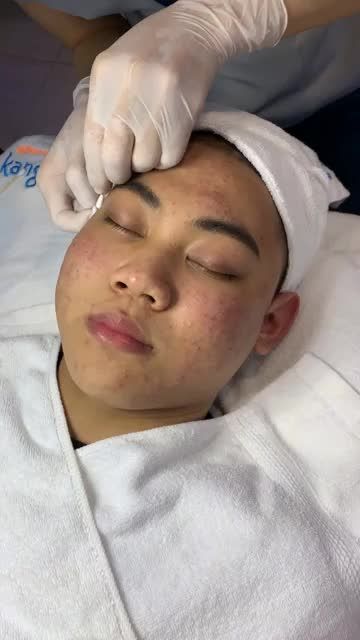 Quy trình điều trị mụn De Acne tại Kangnam