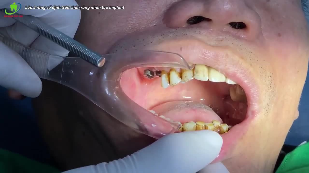QUY TRÌNH LẮP RĂNG SỨ TRÊN CHÂN RĂNG NHÂN TẠO IMPLANT