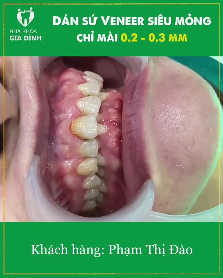 RĂNG TRẮNG TỰ NHIÊN, BỀN CHẮC TRỌN ĐỜI