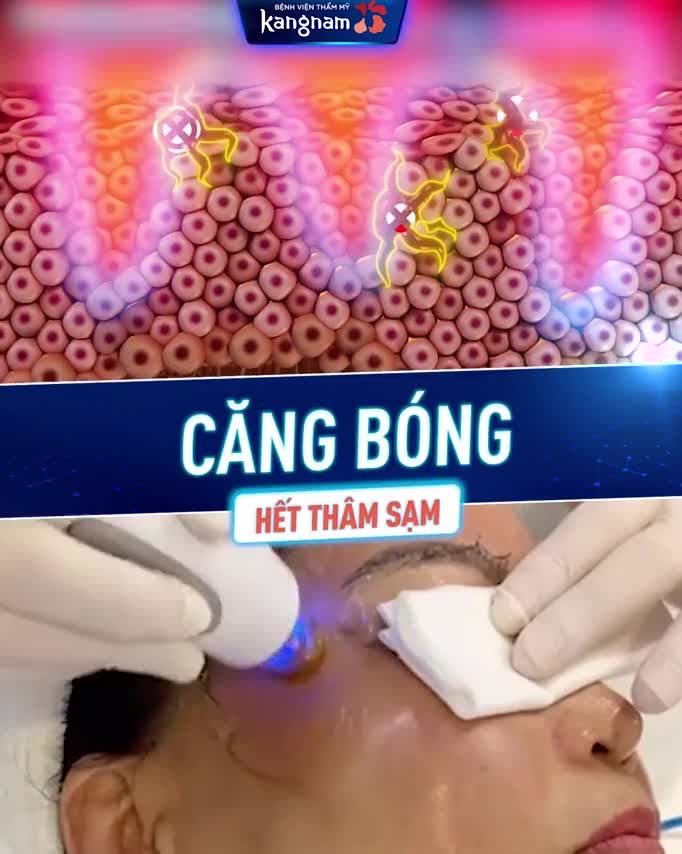 RÃNH NHĂN, THÂM SẠM? "Thay da mới" vói 3 Công nghệ ĐỈNH CAO