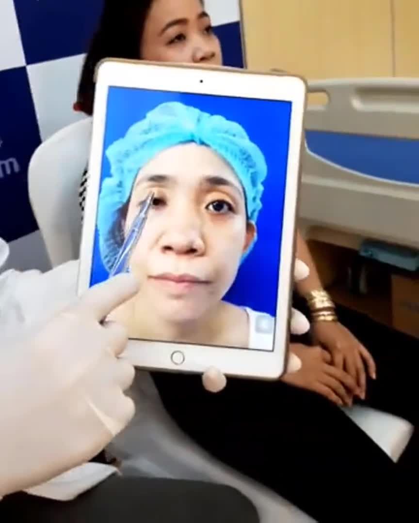 Siêu phầm Chỉnh hình sụp mí sau 1 tháng