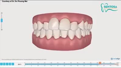 SỰ KỲ DIỆU CỦA INVISALIGN