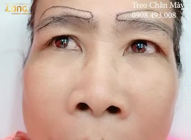 SỰ THẬT SAU KHI PHẪU THUẬT LIỆU CÓ NHƯ BẠN NGHĨ