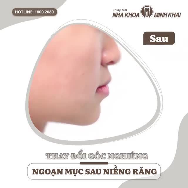 SỰ THAY ĐỔI DIỆU KỲ CỦA GÓC NGHIÊNG SAU NIỀNG RĂNG