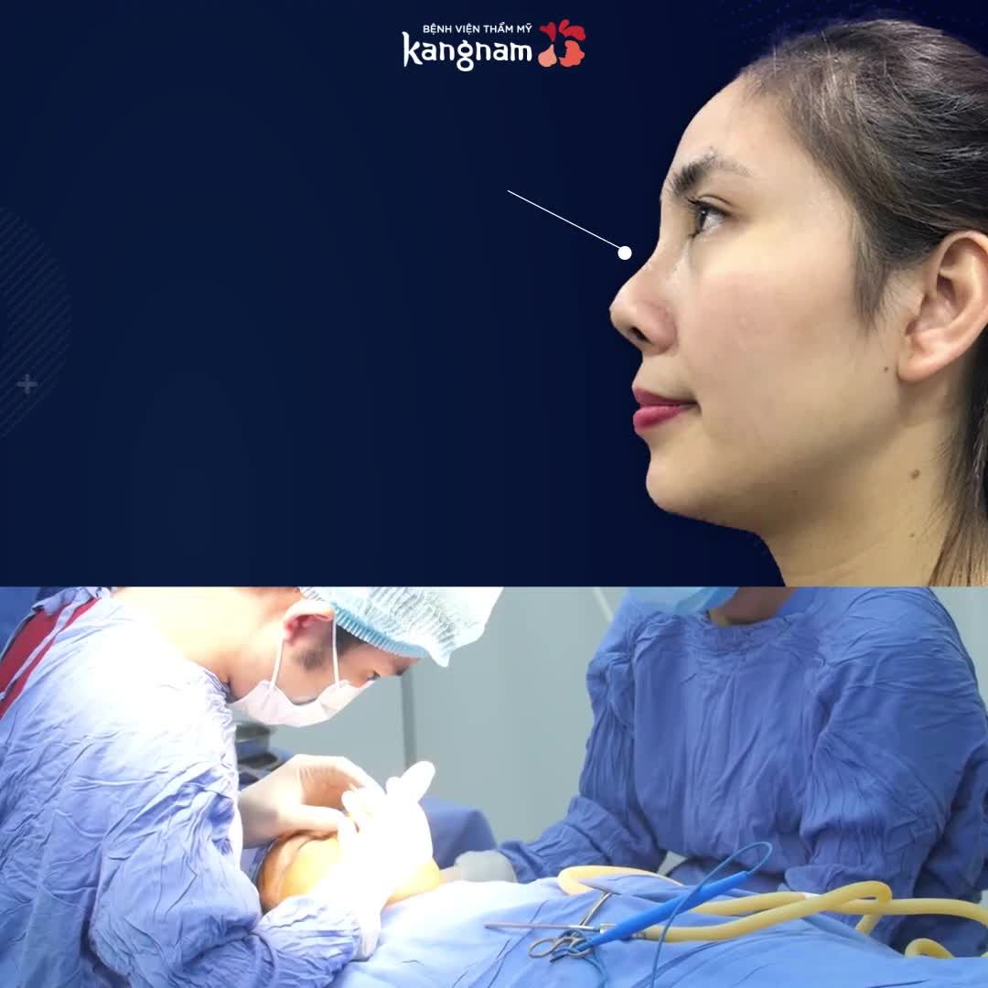 Sửa mũi hếch và cái kết  Nhắn tin nhận Tư vấn A-Z