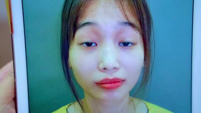 Sụp mí bẩm sinh + Đã từng sửa mí nhưng thất bại  Em gái vỡ òa hạnh phúc sau khi đến Dr.Hải Lê