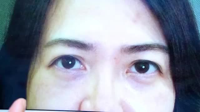 Sụp mí ở tuổi trung niên khắc phục bằng phương pháp nào? Treo cung mày hay cắt mí? Theo dõi video sau đây để có câu trả lời bạn nhé!