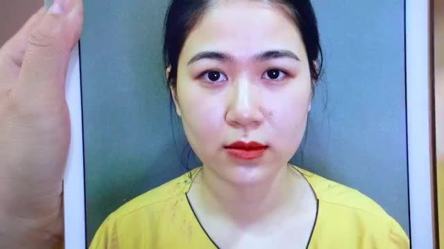 Sụp mí sau sinh khắc phục như thế nào? Cùng theo dõi livestream để có giải pháp bạn nhé