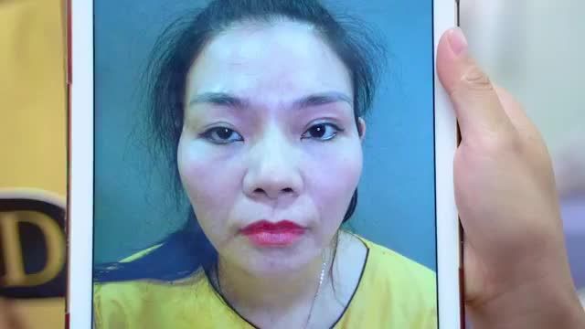 Tại sao sau khi biến chứng lỗi hỏng do thực hiện Cắt mí tại cơ sở không uy tín khách hàng chọn Dr.Hải Lê để sửa lại?