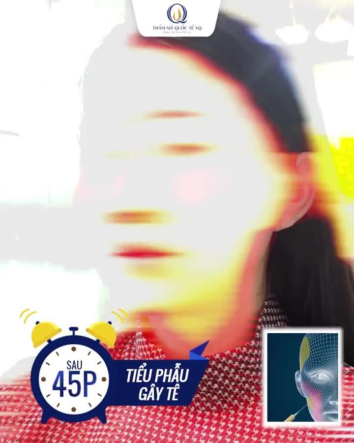 Thái dương lõm - má hóp - gò má cao khiến khuôn mặt già nua, mệt mỏi  Có ngay Stemcells HD - kẻ thù của nếp nhăn , lồi lõm