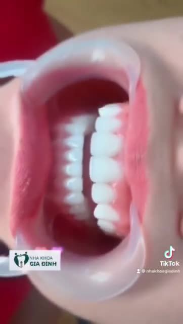 THẨM MỸ RĂNG TẠI NHA KHOA GIA ĐÌNH: RĂNG TRẮNG ĐẸP TỰ NHIÊN – FORM RĂNG CHUẨN TỈ LỆ